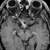 Axial T1WI C+ FS MR shows a markedly enhancing prechiasmatic right optic nerve and chiasm
, consistent with acute optic neuritis.