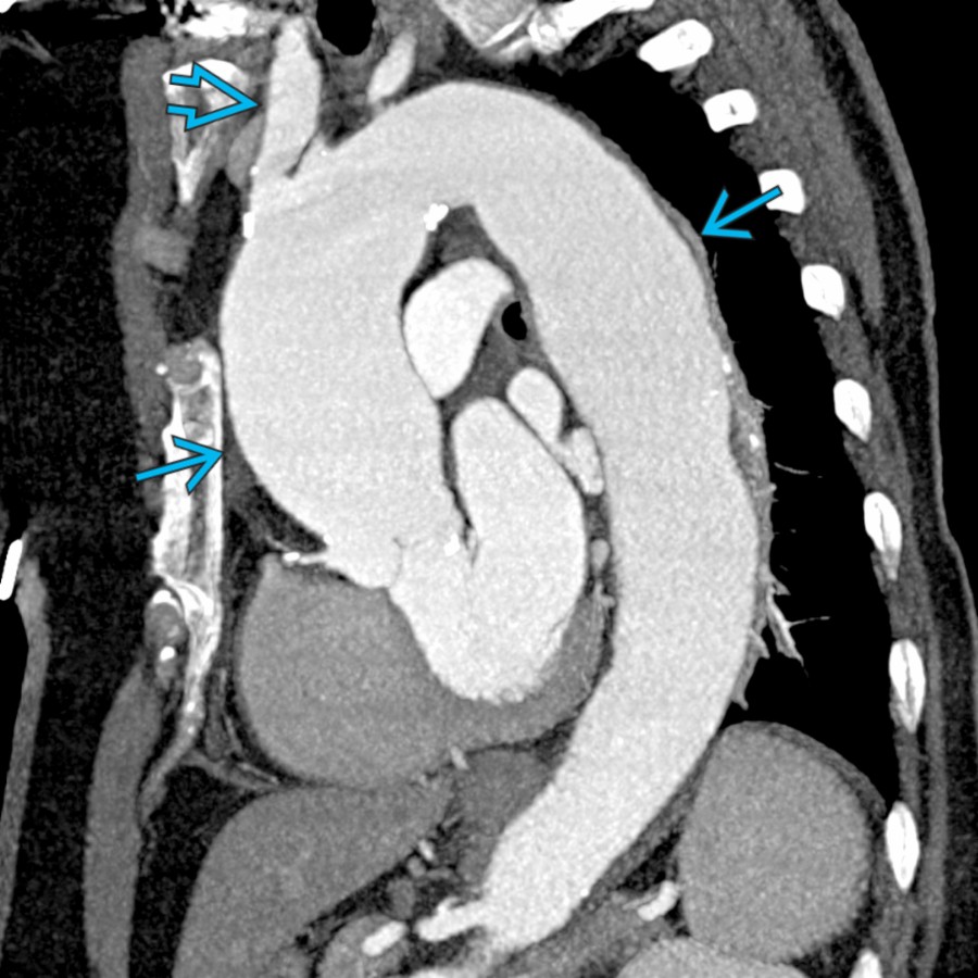 Sagittal CECT MIP in the same patient shows diffuse aneurysmal thoracic aorta
. Note also the aneurysmal right brachiocephalic trunk
. Aneurysm is a very common complication of undiagnosed and untreated GCA only evident after resection.