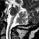 Sagittal T2WI MR in a patient with PSP shows diminished midbrain volume and thinned tectum
.