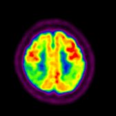 Axial FDG PET in the same patient shows decreased metabolism in both parietal lobes
. Hypometabolism within both the temporal and parietal cortices is typical of AD.