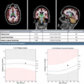 Volumetric MR in a patient FDG PET positive for hypometabolic areas in bilateral temporoparietal lobes, posterior cingulate, and precuneus regions is shown. Bilateral hippocampi and lateral ventricle volumes are in normal range, indicating that FDG PET is more specific than quantitative MR in early AD. (Courtesy M. Matesan, MD.)