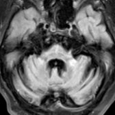 Axial FLAIR MR in a SCA2 patient shows hot cross bun sign (HCBS)
; it is also characteristic of MSA-C and rarely in MJD. Note bright MCP sign
.