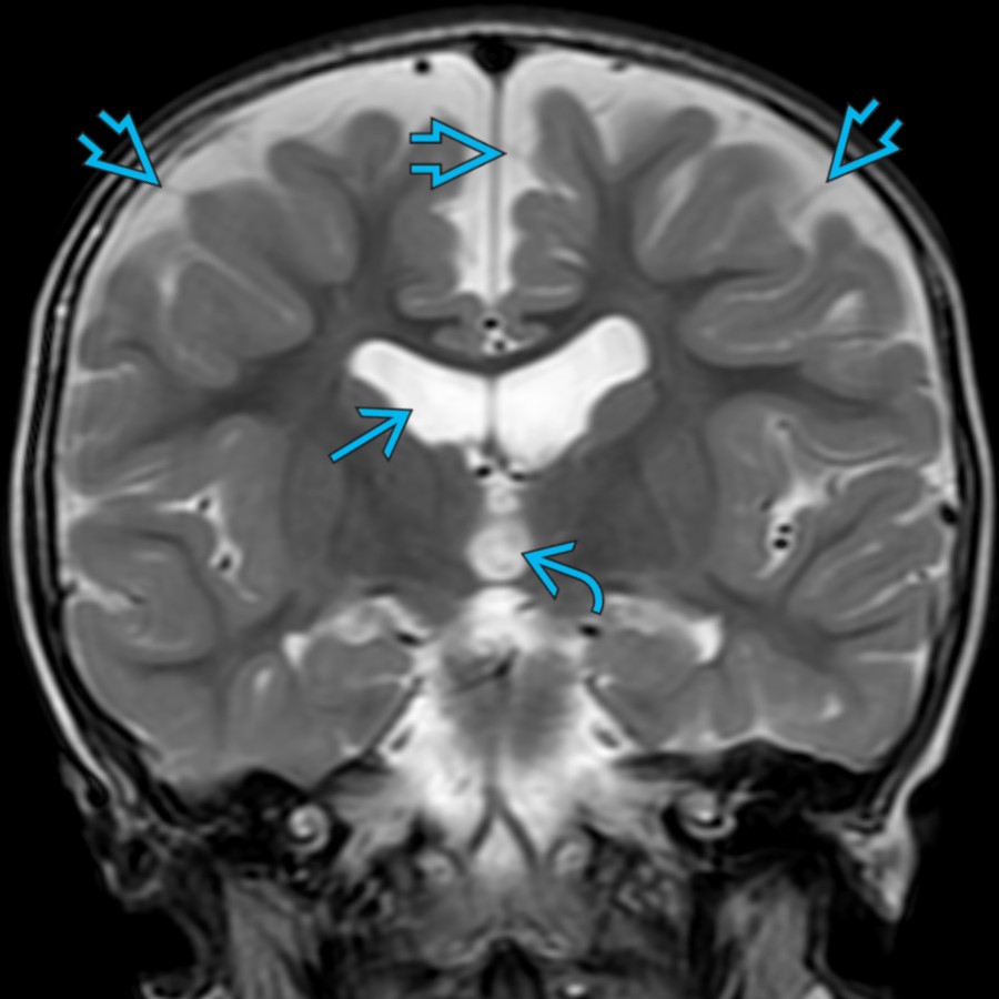 Coronal T2 MR in a 1-year-old with macrocephaly shows mild enlargement of the lateral
& 3rd
ventricles with moderate enlargement of the bifrontal subarachnoid spaces (SAS), which are traversed by normal veins
. Mild ventriculomegaly is often seen in benign enlargement of subarachnoid spaces (BESS).