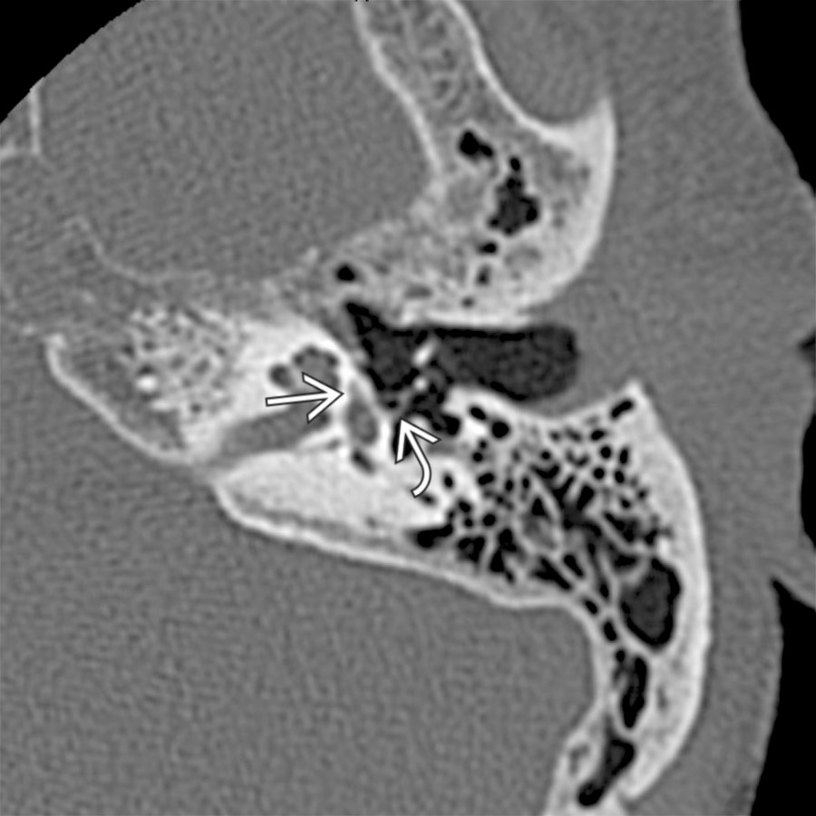 Axial bone CT shows a small lucent plaque of fenestral otosclerosis
thickening the otic capsule bone immediately anterior to the oval window. Note the stapes visualized within the oval window
.