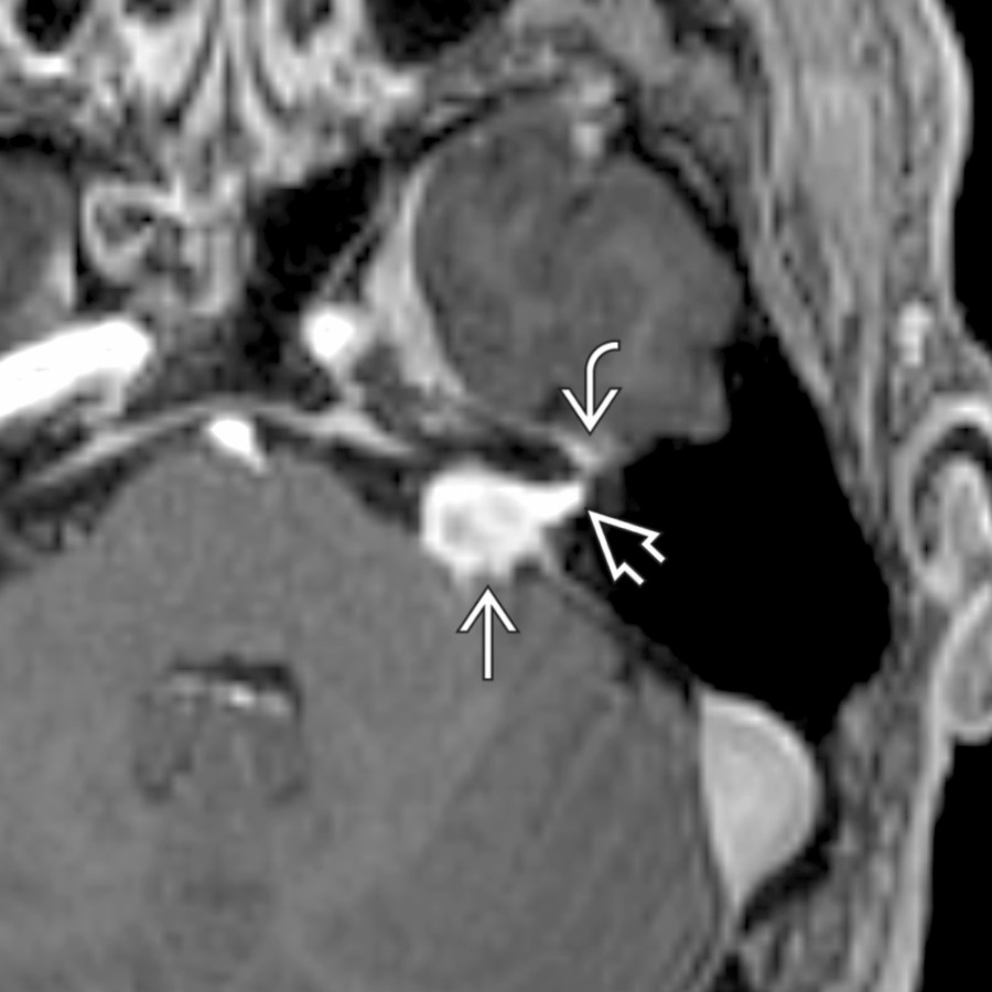 Axial SPGR C+ MR of left facial nerve schwannoma
shows an avidly enhancing CPA-IAC mass with a labyrinthine tail of enhancement
extending to the geniculate ganglion
, which differentiates it from a vestibular schwannoma.