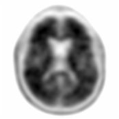 Axial F-18 florbetapir PET in a patient with mild cognitive impairment (MCI) demonstrates homogeneous uptake throughout the brain without clear distinction between gray
and white
matter, consistent with heavy β-amyloid deposition in the gray matter, which is seen in Alzheimer disease (AD).
