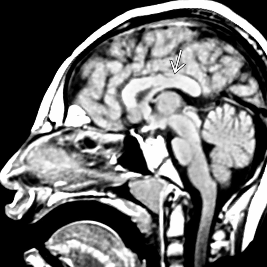 Midline sagittal T1 MR in a child with severe microcephaly shows a short, thick corpus callosum
.