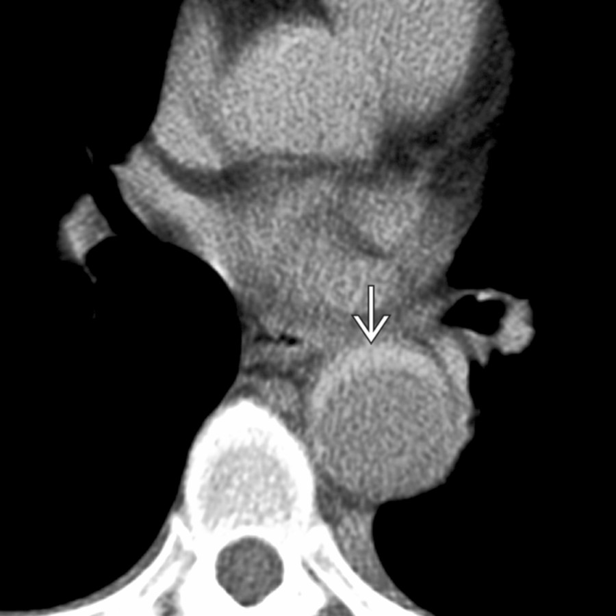 Axial CECT shows hyperdense, thickened aortic wall
in a hypertensive patient who presented to the ER with back pain. This finding can be missed on an enhanced exam.