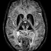Axial SWI MR in the same patient shows diffuse linear hypointense iron deposition in the cortex
, basal ganglia
, & thalami
. ACP shows widespread excessive iron deposition, maximum degree among all NBIAs. Prominent T2 hyperintensity in WM & brain atrophy are common. Serum ferritin is high in ACP but low in NFT, both adult-onset NBIA.