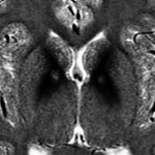Axial T2WI MR in PKAN (Hallervorden-Spatz syndrome), the most common NBIA, shows classic eye of the tiger sign. Note globi pallidi (GP) hypointensity
due to iron deposition with central hyperintensity
due to neuronal loss, gliosis, & cavitation of neuropil. The central T2 hyperintensity can be predominant MR finding initially with surrounding GP T2 hypointensity developing later.