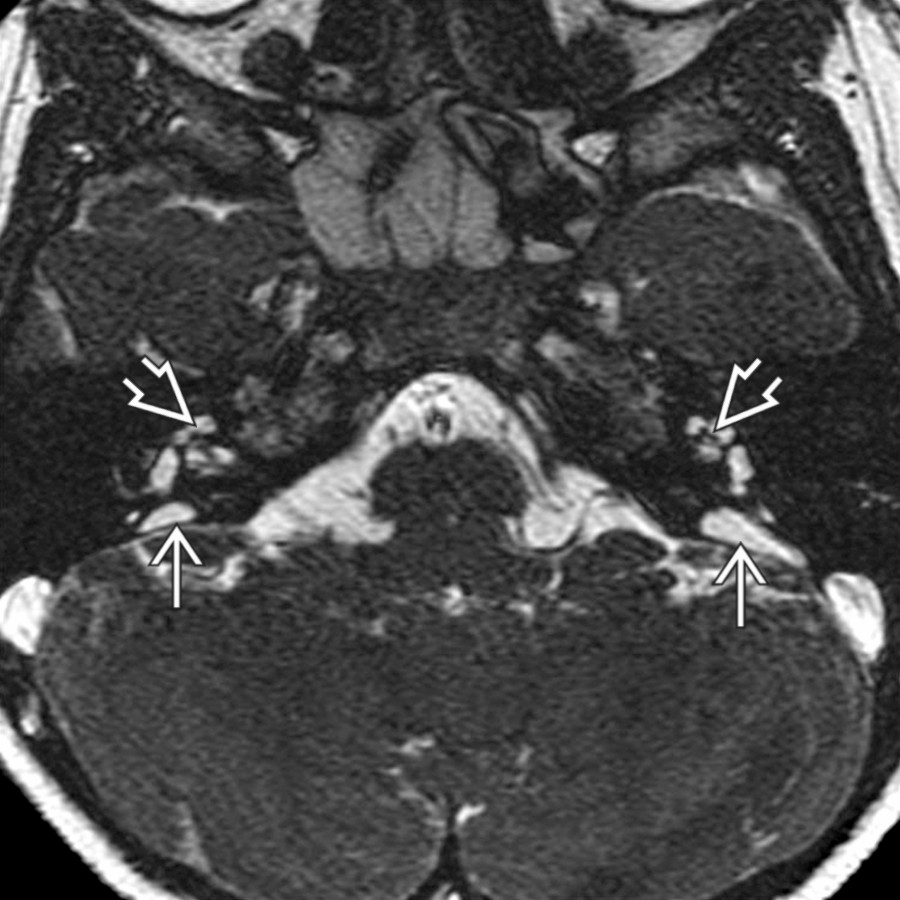 Axial high-resolution FSE MR in a child with bilateral hearing loss shows bilateral enlargement of the extraosseous endolymphatic sacs
and cochlear modiolar deficiency
.