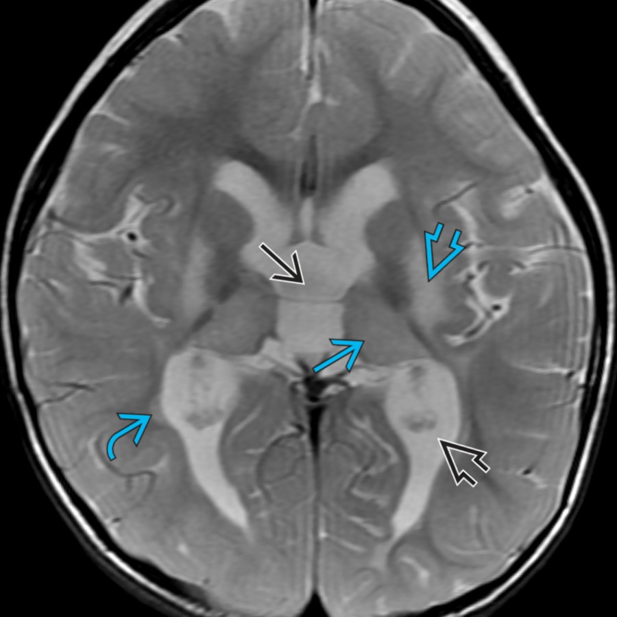 Axial T2 MR in a 2-year-old with a history of perinatal HII shows symmetric areas of signal abnormality & volume loss involving the thalami
, putamina
, & periventricular white matter
, resulting in enlargement of the lateral
& 3rd
ventricles.