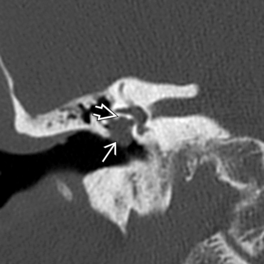 Coronal bone CT in the same patient reveals the FNS involving the midtympanic segment
of the facial nerve. Notice that the facial nerve bony canal "opens" into the middle ear mass
.
