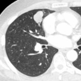 Axial CECT of a patient with a history of chronic cough and blood-tinged sputum shows a polylobular middle lobe soft tissue mass
that exhibits an endobronchial component
and obstructs a small airway in the middle lobe. Carcinoid tumor was diagnosed at surgery.
