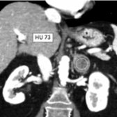 Coronal portal venous-phase CT in the same patient shows mild enhancement of the left adrenal mass
(HU 73).