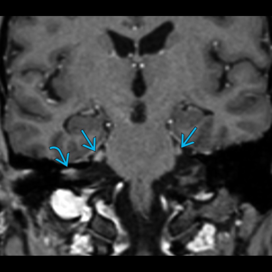 Coronal angled T1 C+ MPRAGE MR reformat in a patient with Miller Fisher syndrome (MFS) shows mild thickening and enhancement of right facial (CNVII)
and bilateral trigeminal (CNV)
nerves.