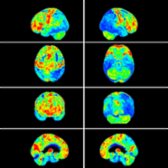 Surface projection in same patient shows additional hypometabolism in the R > L precuneus
, parietal
, and posterior temporal lobes
. Findings are consistent with posterior cortical atrophy. Aβ and tau pathology was confirmed by cerebrospinal fluid (CSF) biomarkers.