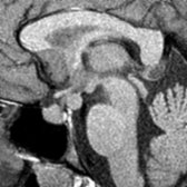 Sagittal T1WI MR in an 8-year-old girl with precocious puberty shows a classic pedunculated "collar button" HH
. The lesion is interposed between the infundibular stalk
anteriorly and the mammillary bodies
posteriorly. HHs are classically isointense with gray matter.