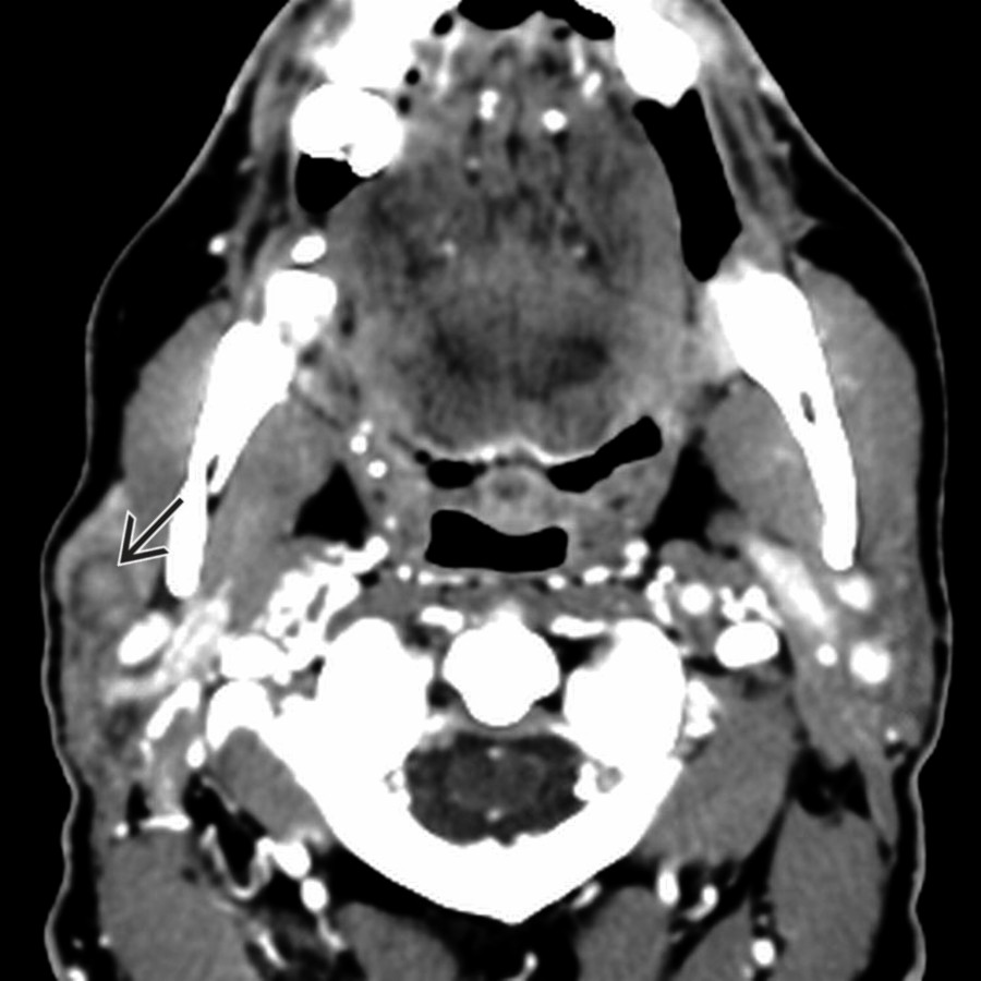 Axial CECT in a patient with neurofibromatosis type 2 shows a round, subcentimeter mass
in the anterior aspect of the superficial parotid lobe. This schwannoma has heterogeneous enhancement but no cystic areas because of its small size.
