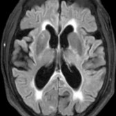 Axial FLAIR MR in a patient with tremor, cerebellar ataxia, and cognitive decline shows diffuse parenchymal volume loss, WM hyperintensities
, and hyperintensity in the splenium of the corpus callosum
(corpus callosum splenium sign).