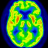 Axial PET of the same patient shows preserved metabolism in frontal
& temporal
lobes. (Courtesy S Behnia, MD.)