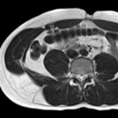 Axial T2 HASTE MR in a younger male patient shows more bulky abdominal wall musculature with little intermuscular fat.