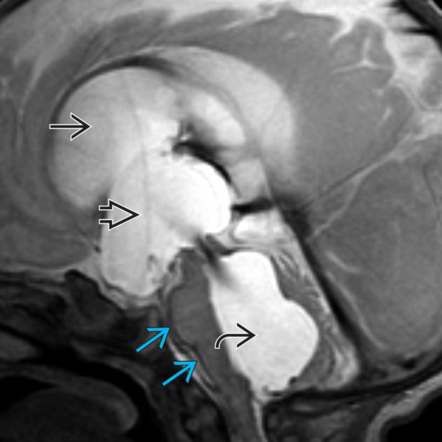 Sagittal T2 MR in a 1-month-old former premature infant with posthemorrhagic hydrocephalus shows marked enlargement of the lateral
, 3rd
, & 4th
ventricles. Note the dark hemosiderin lining the pial surface of the brainstem
from prior intraventricular hemorrhage (IVH).
