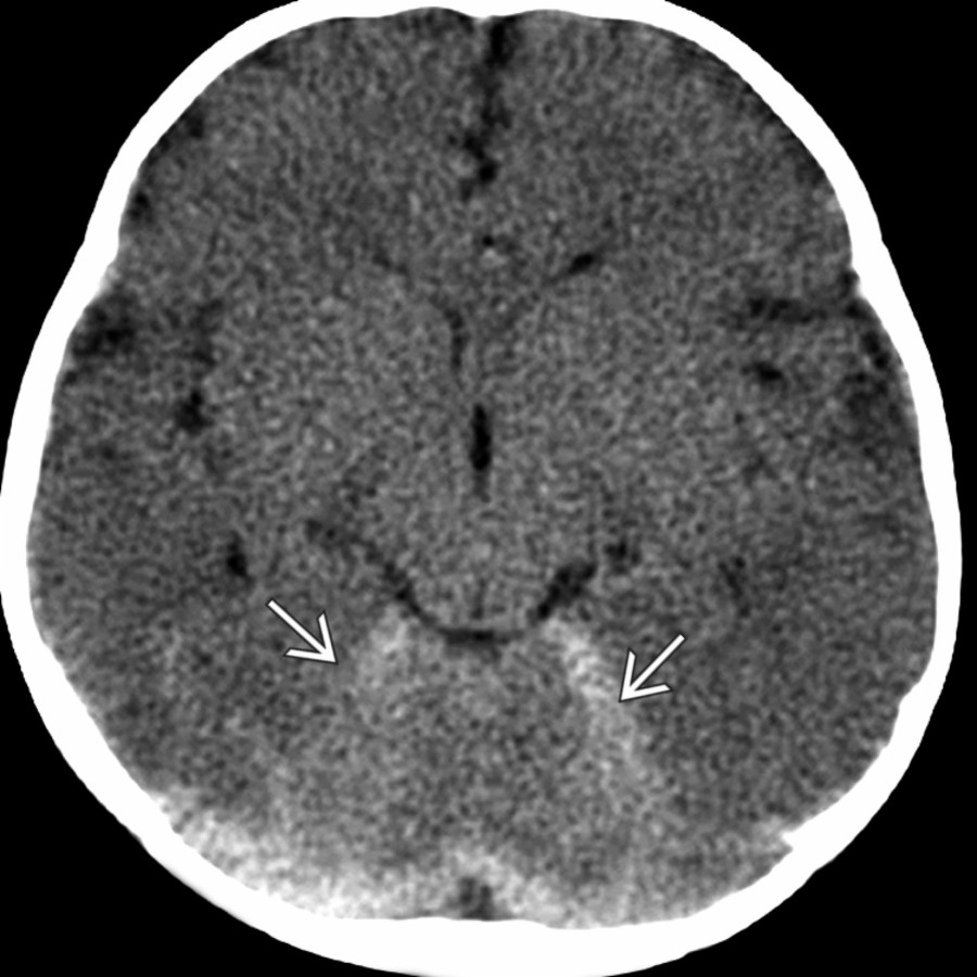 Axial NECT shows generally poor gray matter-white differentiation & subdural blood along the tentorium
in a 5-month-old with a shaking-induced injury.