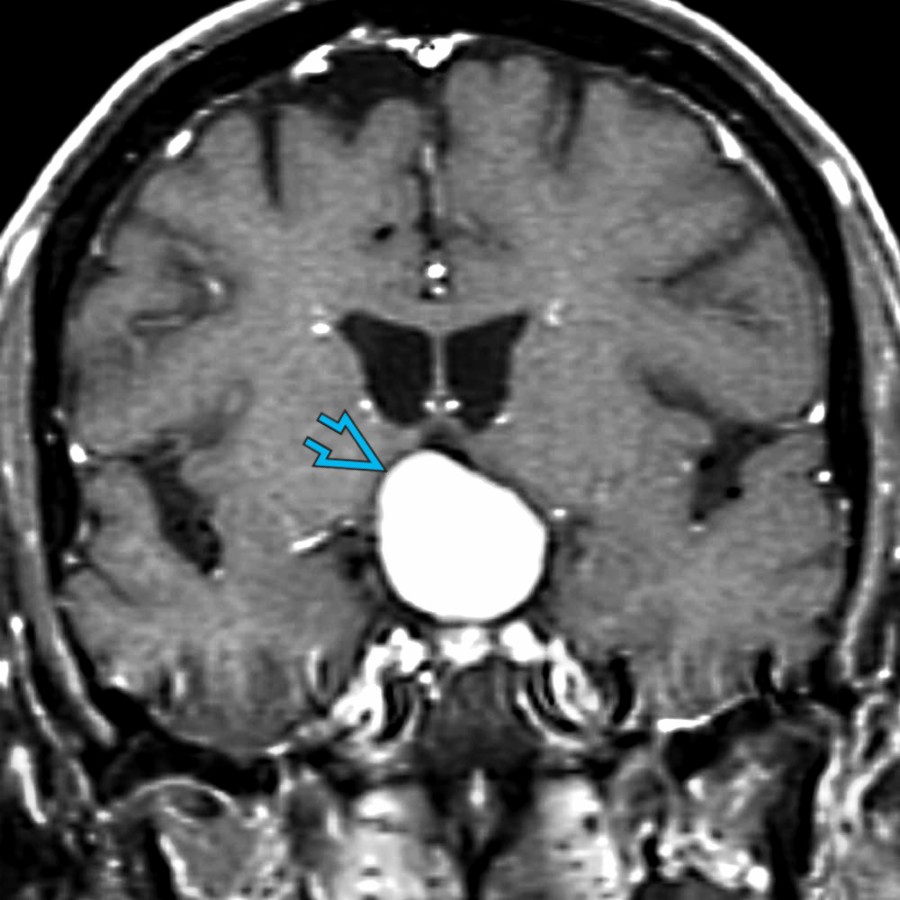 Coronal T1 C+ MR shows a diffusely enhancing suprasellar mass
that involves the infundibulum. A pituicytoma was diagnosed at resection. These rare tumors are WHO grade 1 and usually arise along the infundibulum or neurohypophysis. (Courtesy A.V. Hasso, MD.)