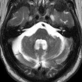 Axial T2 MR in the same patient shows atrophy of the middle cerebellar peduncles with symmetric hyperintensities
(MCP sign). The patient was diagnosed with definite FXTAS and had 166 CGG repeats on molecular genetic testing.