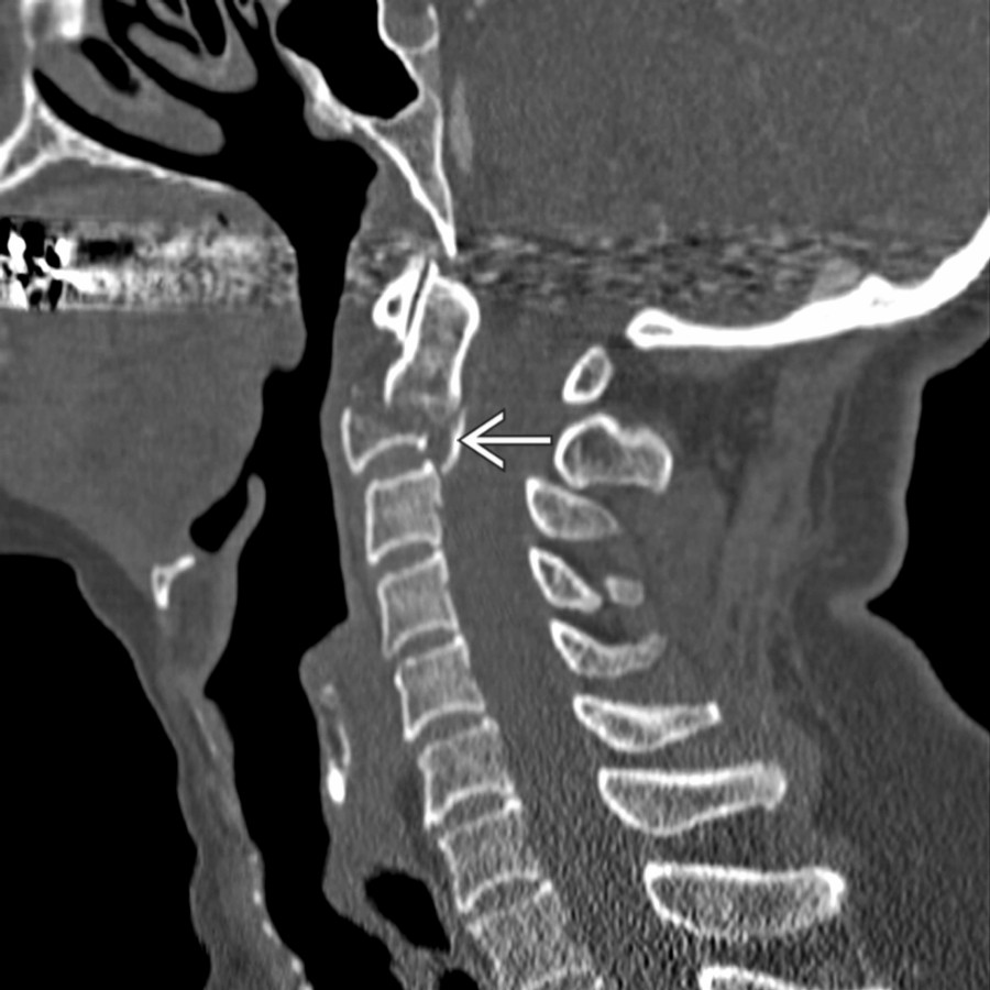 Sagittal bone CT shows a comminuted C2 body fracture with characteristic retropulsion of the posterior cortex
. Additional burst fractures are commonly present elsewhere in the spine.