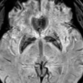 Axial SWI MR in the same patient shows excess iron deposition in the GP & putamina, which also lines the cystic degeneration. Iron deposition in frontal lobes & mild cerebral & cerebellar atrophy may be seen. Rarely, eye of the tiger sign (characteristic of PKAN) may be seen in NFT.
