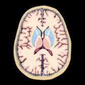Axial graphic demonstrates brain anatomy and expected area of uptake (blue) in the head of the caudate
and putamen
.