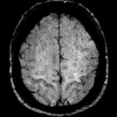 Axial T2* SWI MR demonstrates curvilinear hypointensity along the cortical gray matter of bilateral precentral gyri
. The T2* SWI technique accentuates the T2 hypointensity seen in the precentral gyrus gray matter of ALS patients.