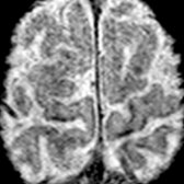 Axial 3D SWI in the same patient at the level of vertex shows rim of low signal in bilateral precentral gyri (motor cortex)
. This finding is nonspecific and may be due to iron and heavy metals accumulating in the cortex of older patients.