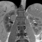 Coronal T1 MR in a 34-year-old woman with hypertension and hypokalemia shows an intermediate-signal left adrenal lesion
. Note the incidental high-signal right renal cyst
.
