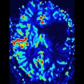 MR perfusion study CBF map in a patient with acute right hemiparesis shows ↓ blood flow
(blue area) in the left MCA distribution.