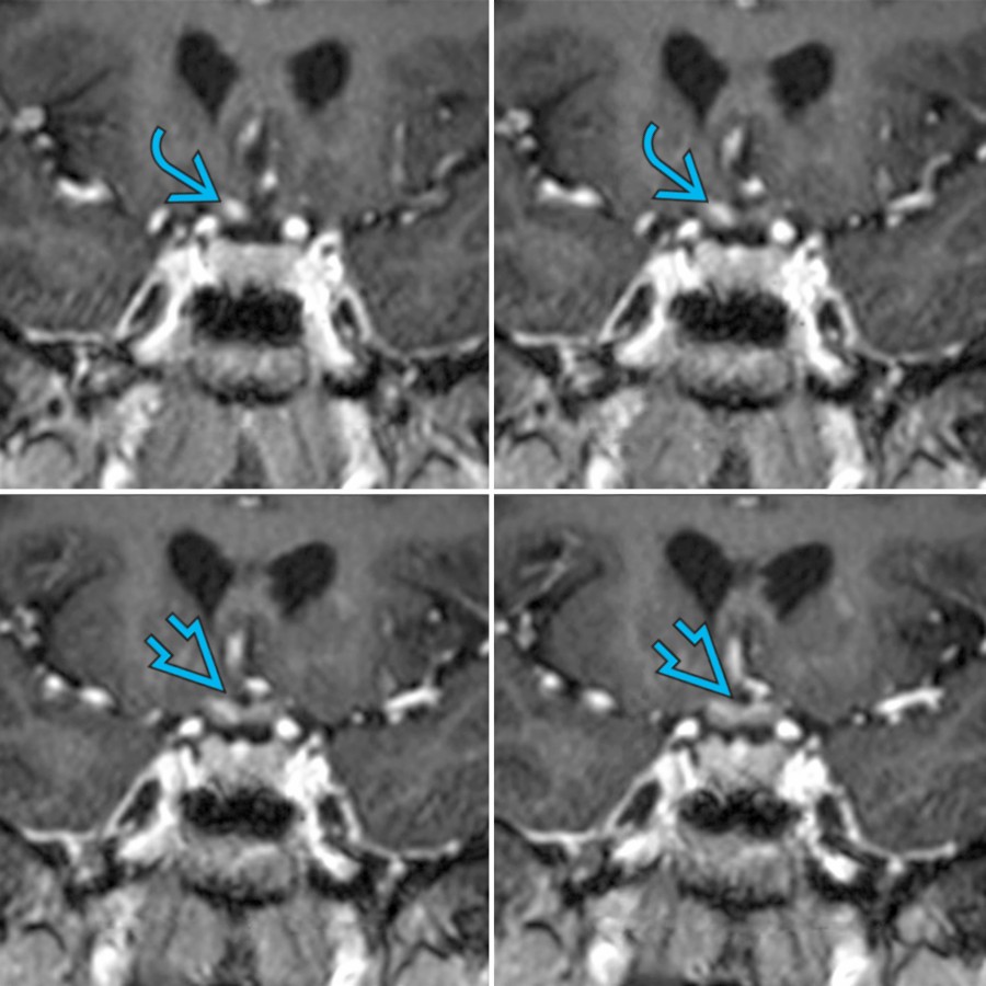 Coronal T1 C+ MR images in a patient with AQP4 antibody (+) NMOSD show enhancement along the prechiasmatic right optic nerve
and the optic chiasm
.