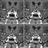 Coronal T1 C+ MR images in a patient with AQP4 antibody (+) NMOSD show enhancement along the prechiasmatic right optic nerve
and the optic chiasm
.