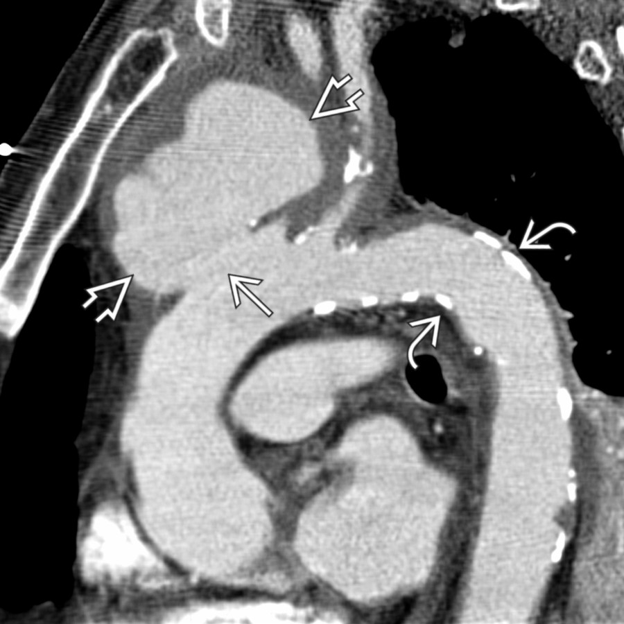Sagittal oblique reformation in the same patient depicts the ulceration
and large pseudoaneurysm
along the proximal arch. Note extensive calcific atherosclerosis
.
