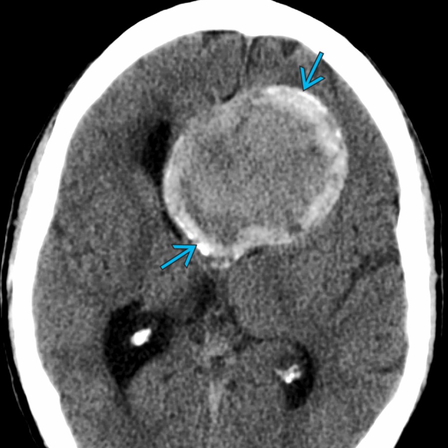 Axial NECT shows a huge, well-delineated, hyperdense suprasellar mass with rim calcifications
. A giant, mostly thrombosed, saccular aneurysm was diagnosed and treated surgically. MR may show a laminated appearance with pulsation artifact if the aneurysm is patent.