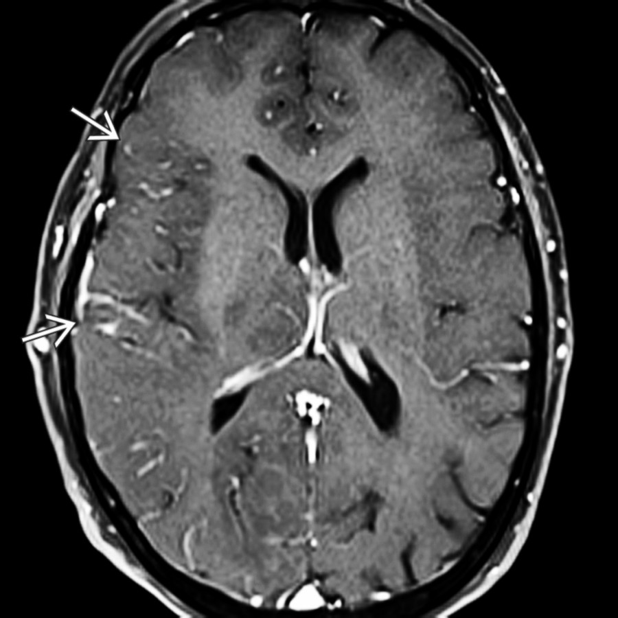 Axial T1 C+ FS MR shows cerebral hyperperfusion in status epilepticus in a 52-year-old woman with left-sided weakness following prolonged seizure. Note the increased intravascular, sulcal enhancement in the right temporal lobe compared to the left hemisphere
.