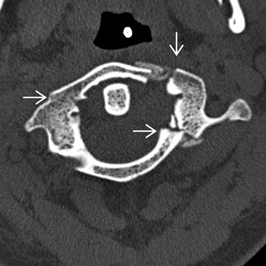 Axial bone CT shows multiple fractures of the C1 ring
. Lateral displacement in this patient indicates rupture of the transverse ligament of dens and resultant instability.