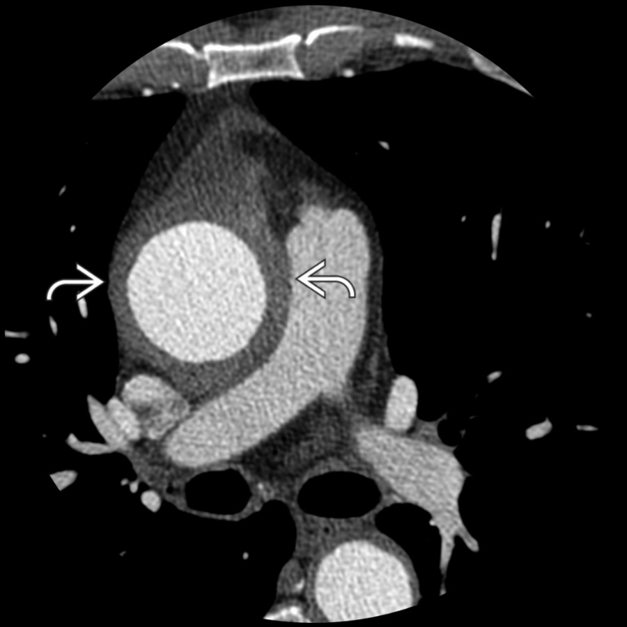 Axial CECT in a patient with Takayasu arteritis (TA) shows marked thickening of the wall of the ascending thoracic aorta
. The thoracic aorta and its branches, particularly the left subclavian artery, are the most commonly affected vessels in TA.