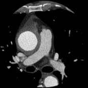 Axial CECT in a patient with Takayasu arteritis (TA) shows marked thickening of the wall of the ascending thoracic aorta
. The thoracic aorta and its branches, particularly the left subclavian artery, are the most commonly affected vessels in TA.