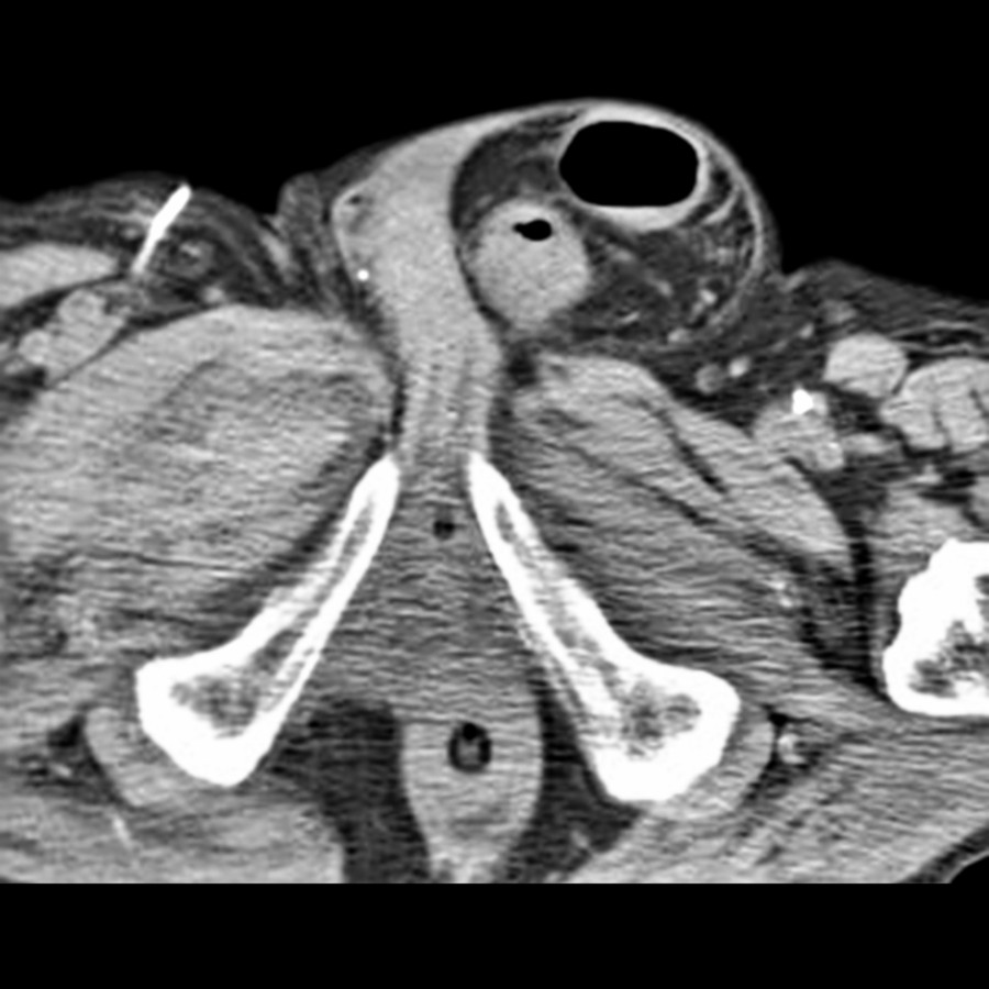 Axial CECT shows a left inguinal hernia containing a sigmoid colon. Also note the right thigh hematoma.