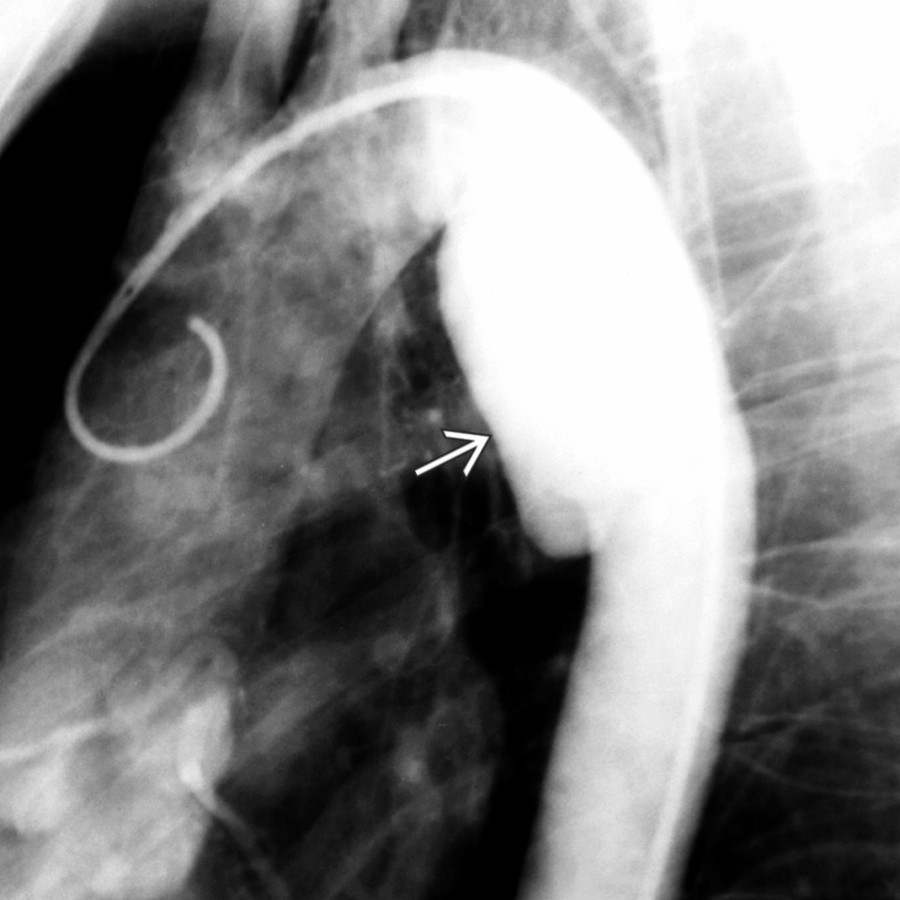 Sagittal oblique aortogram following blunt chest trauma shows a large pseudoaneurysm
at the aortic isthmus. CTA has largely replaced conventional angiography for the diagnosis of traumatic aortic injury (TAI) but still plays an important role in TAI treatment with endovascular stent graft placement.