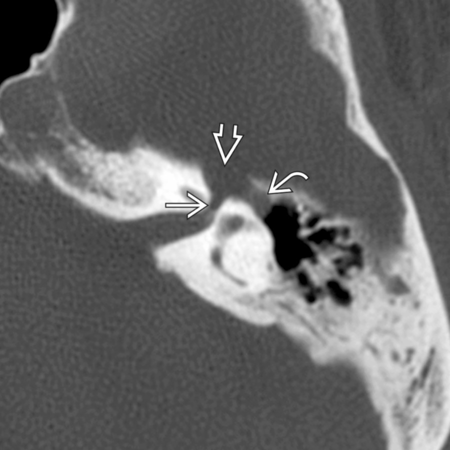 Axial bone CT in a patient with CNVII paresis shows tubular enlargement of the distal labyrinthine segment
, geniculate fossa
, and anterior tympanic segment
of the CNVII canal. Involvement of multiple segments of the facial nerve, as in this case, is highly suggestive of FNS.