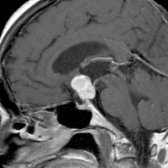 Sagittal T1 C+ MR in a 45-year-old man with visual changes shows a solid enhancing suprasellar mass
. Papillary craniopharyngioma was diagnosed at resection. Papillary craniopharyngiomas are WHO grade 1 tumors; however, they are more commonly solid, noncalcified lesions.