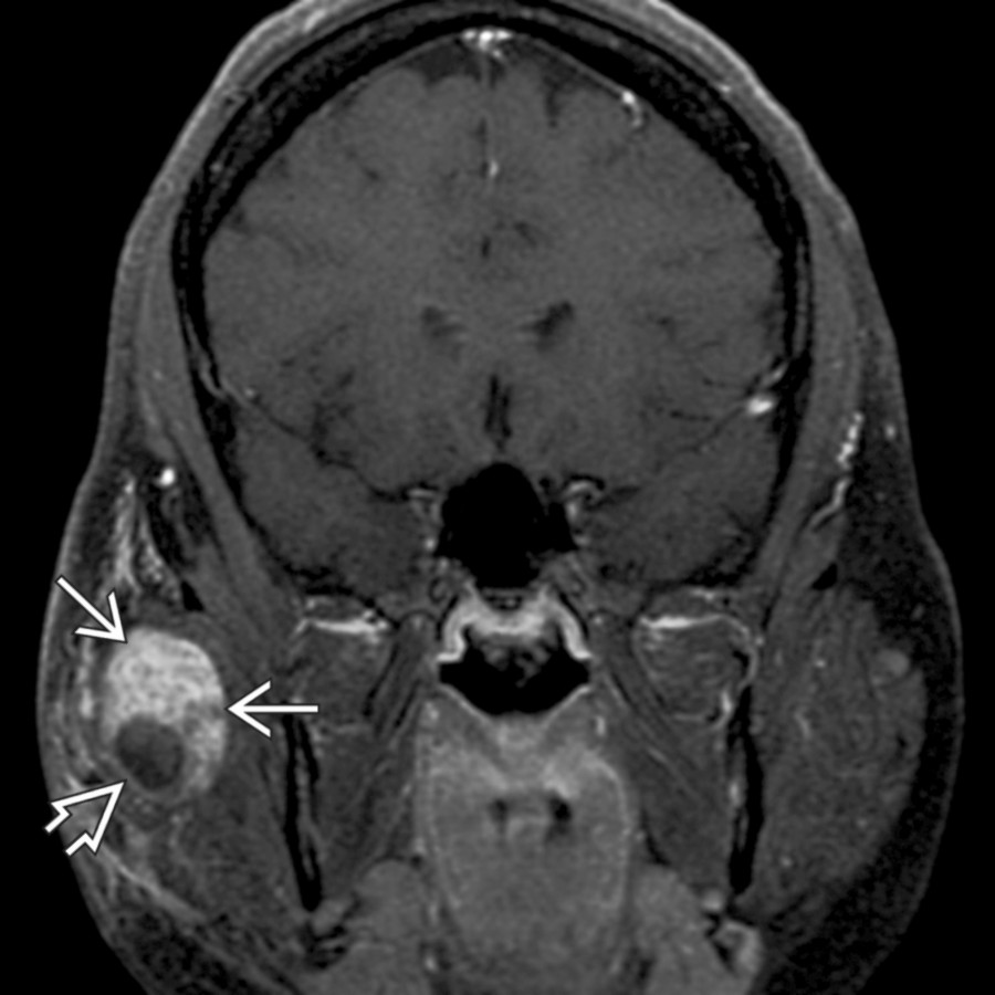 Coronal T1 C+ FS MR shows an oval, heterogeneously enhancing mass
with a large intramural cyst
in the superficial parotid lobe. The imaging appearance is similar to schwannomas in other anatomic locations.